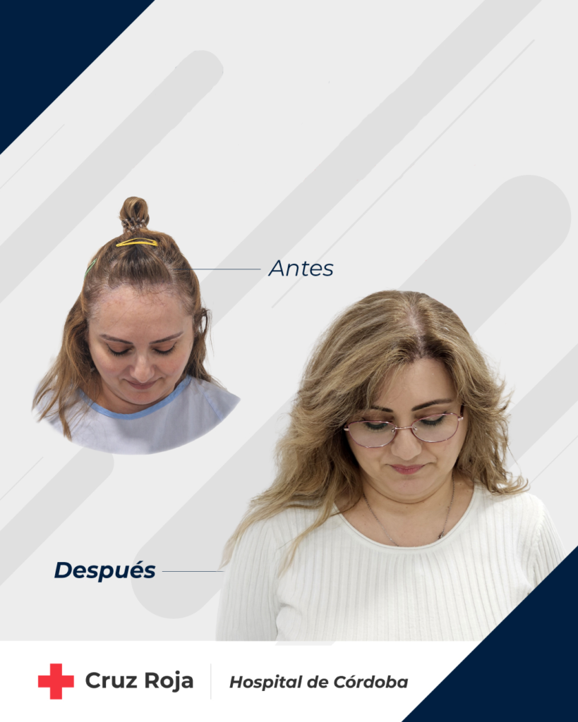 Antes y despues trasplante capilar mujer