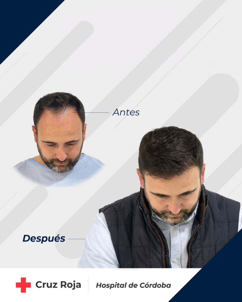 Antes y despues trasplante capilar hombre