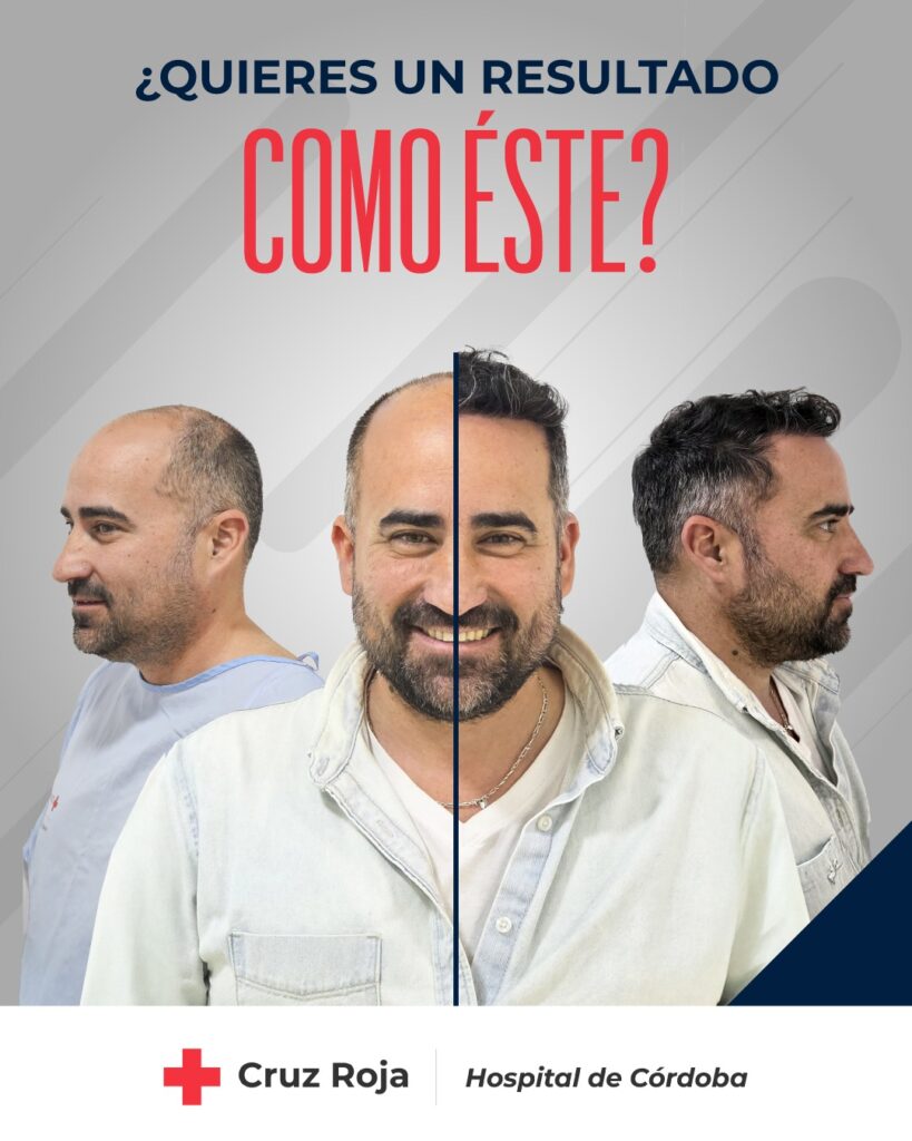 Antes y después trasplante capilar